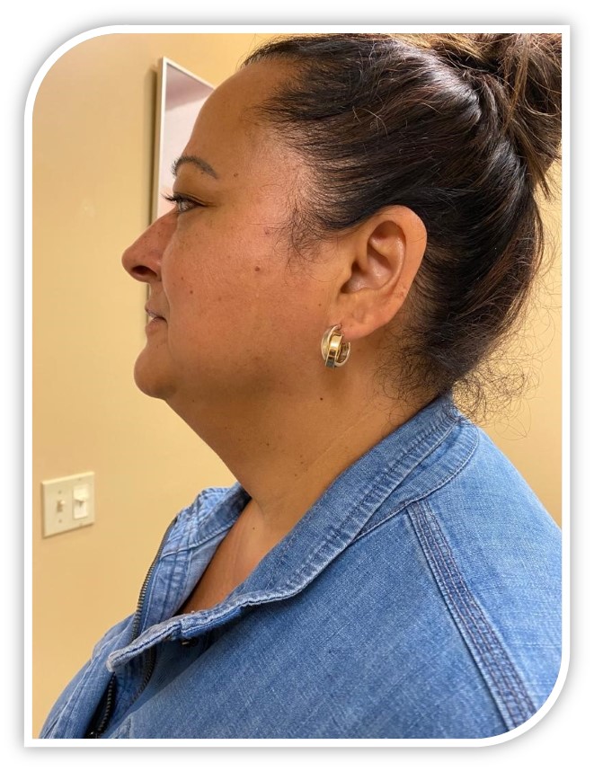 After Hifu Neck Lift